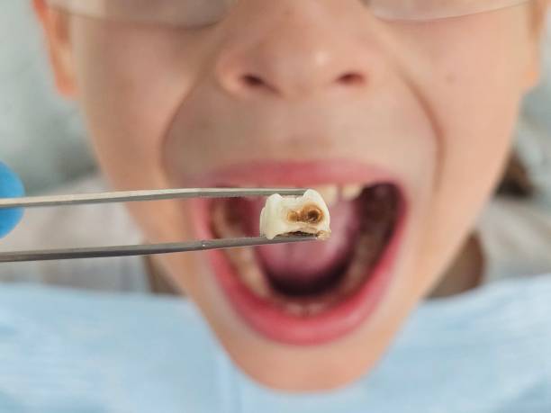 Best Urgent Care for Lost Fillings or Crowns in Mill Bay, AK